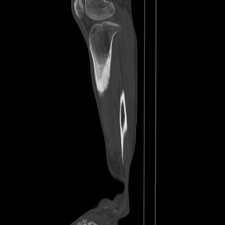 Brodie abscess - tibia (Radiopaedia 66028-75204 Sagittal bone window 55).jpg