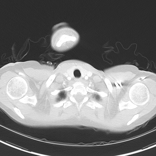 Bronchial atresia (Radiopaedia 73677-84470 Axial lung window 6).jpg