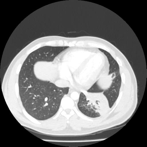 Bronchial carcinoid (Radiopaedia 80013-93291 Axial lung window 93).jpg
