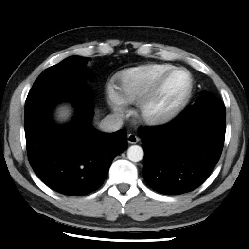 Bronchial carcinoid tumor (Radiopaedia 67377-76764 A 46).jpg