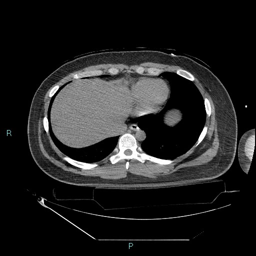 Bronchial carcinoid tumor (Radiopaedia 78272-90870 Axial non-contrast 83).jpg