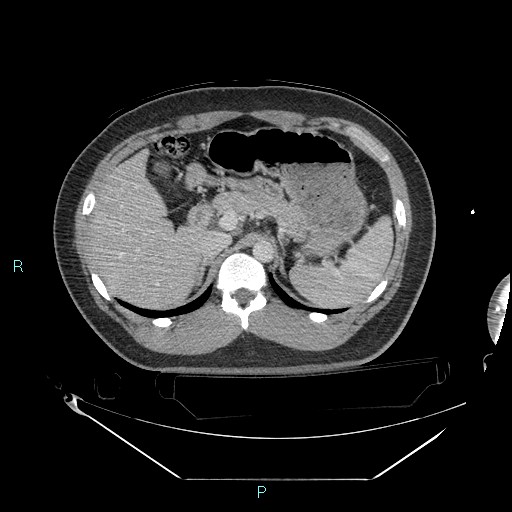 File:Bronchial carcinoid tumor (Radiopaedia 78272-90870 C 124).jpg