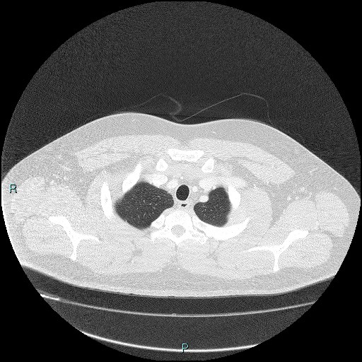 Bronchial carcinoid tumor (Radiopaedia 78272-90875 Axial lung window 4).jpg