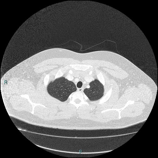 Bronchial carcinoid tumor (Radiopaedia 78272-90875 Axial lung window 5).jpg