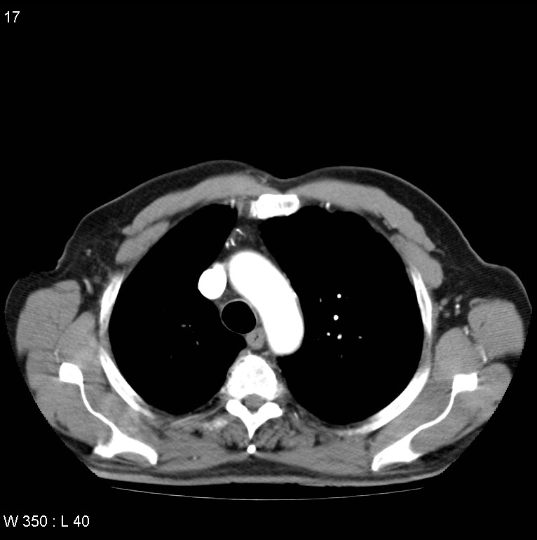 Bronchial carcinoid tumor with right lower lobe collapse (Radiopaedia 29060-29422 A 16).jpg
