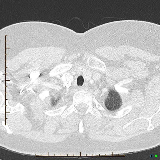 File:Bronchial diverticula (Radiopaedia 79512-92676 Axial lung window 3).jpg