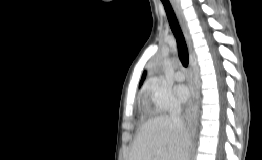 Bronchial mucoepidermoid carcinoma (Radiopaedia 57023-63895 Sagittal 107).jpg