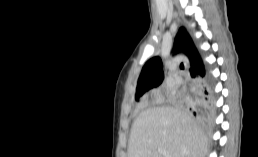 Bronchial mucoepidermoid carcinoma (Radiopaedia 57023-63895 Sagittal 83).jpg