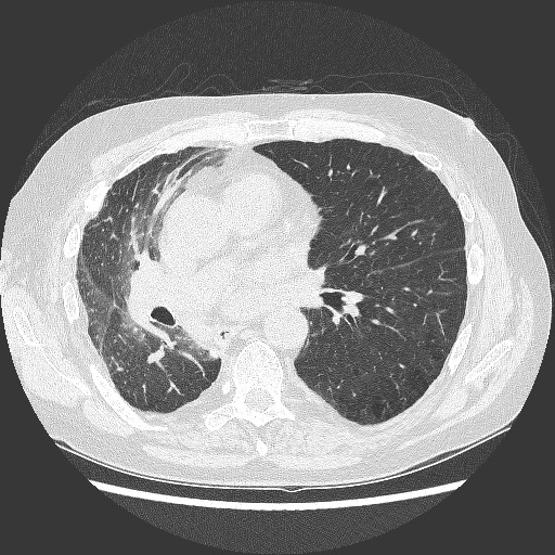 File:Bronchial stenosis - lung transplant (Radiopaedia 73133-83848 C 7).jpg