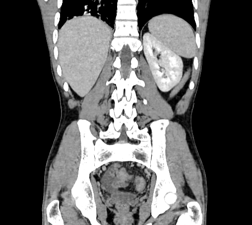 Bronchiectasis in Crohn disease (Radiopaedia 60311-67977 C 61).jpg