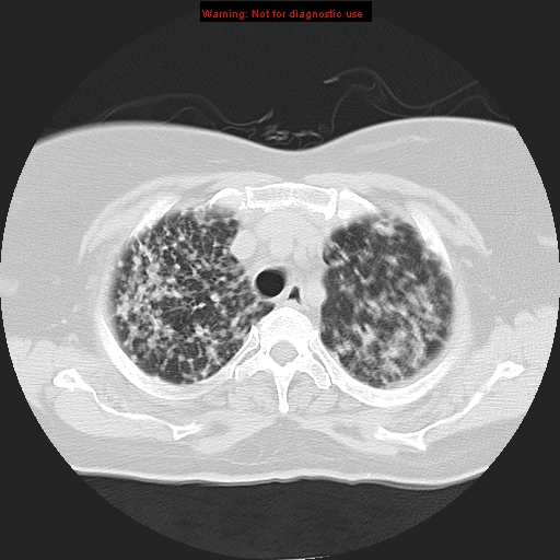 Bronchoalveolar carcinoma (Radiopaedia 13224-13233 Axial lung window 12).jpg