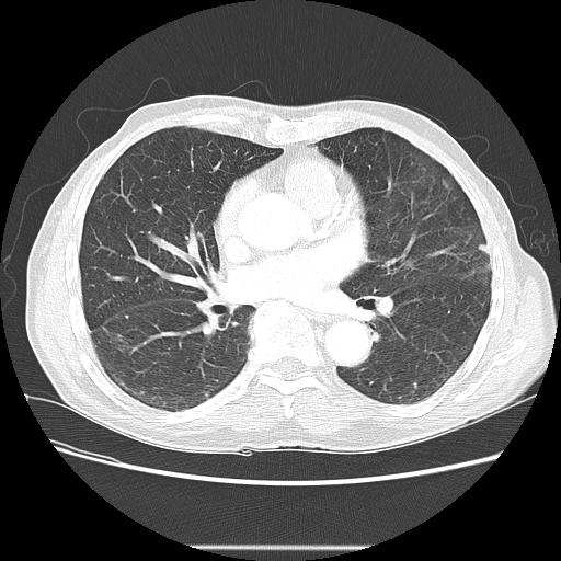 Bronchocele (Radiopaedia 17097-16795 Axial lung window 66).jpg