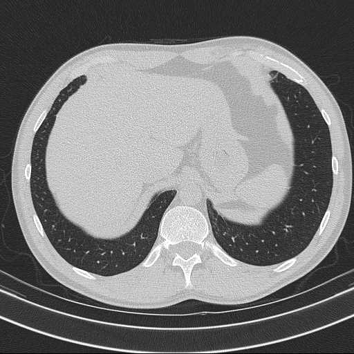Bronchocele (Radiopaedia 60676-68429 Axial lung window 65).jpg