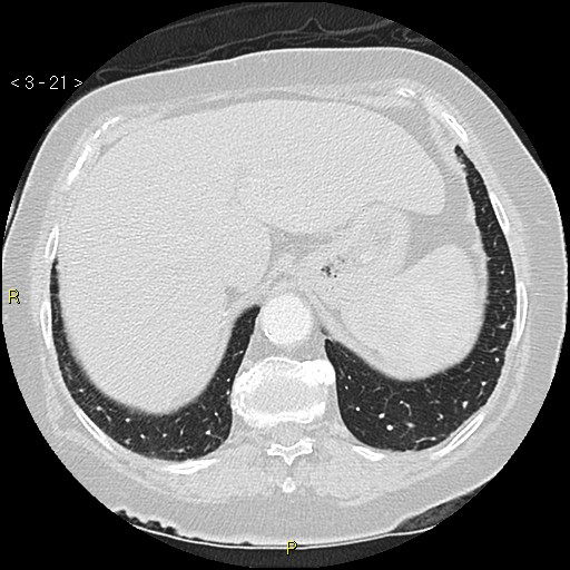 Bronchogenic carcinoma as an incidental finding (Radiopaedia 16453-16130 Axial lung window 21).jpg