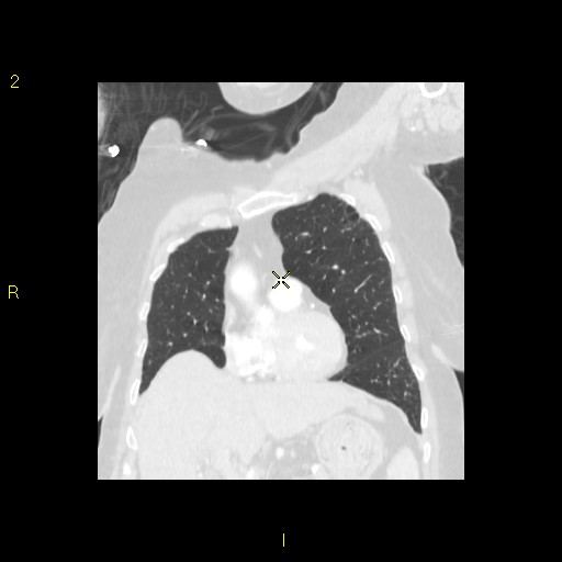 File:Bronchogenic carcinoma as an incidental finding (Radiopaedia 16453-16130 Coronal lung window 19).jpg