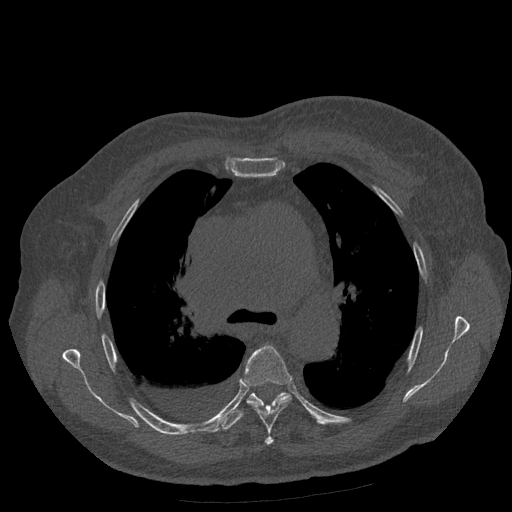Bronchogenic carcinoma with metastatic lymphadenopathy (Radiopaedia 37671-39569 Axial bone window 21).jpg