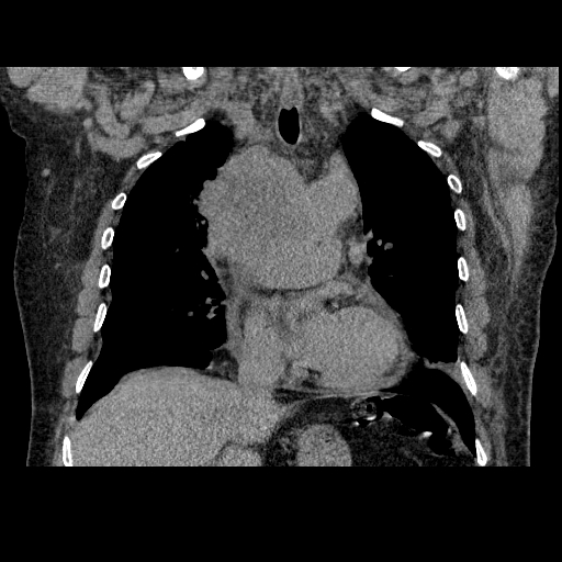 File:Bronchogenic carcinoma with metastatic lymphadenopathy (Radiopaedia 37671-39569 Coronal non-contrast 21).jpg