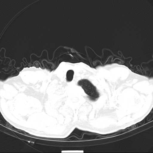 Bronchopleural fistula - postoperative complication (Radiopaedia 21020-20947 Axial lung window 3).jpg