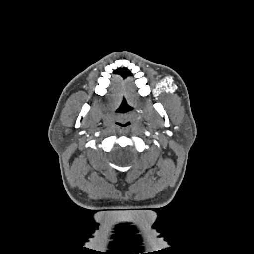 Buccal fat pad arteriovenous malformation (Radiopaedia 70936-81144 D 200).jpg