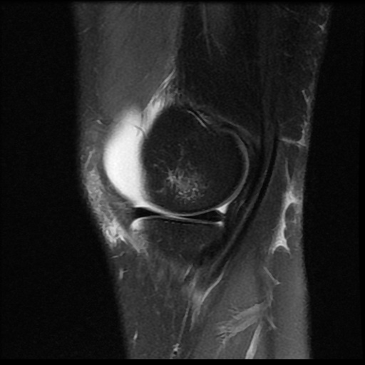 File:Bucket handle meniscus tear (Radiopaedia 56916-63751 Sagittal PD fat sat 16).jpg
