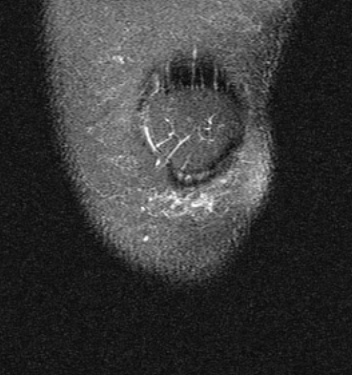 File:Bucket handle tear - medial meniscus (Radiopaedia 79028-91942 Coronal PD fat sat 24).jpg