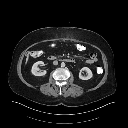 Buried bumper syndrome - gastrostomy tube (Radiopaedia 63843-72575 A 36).jpg