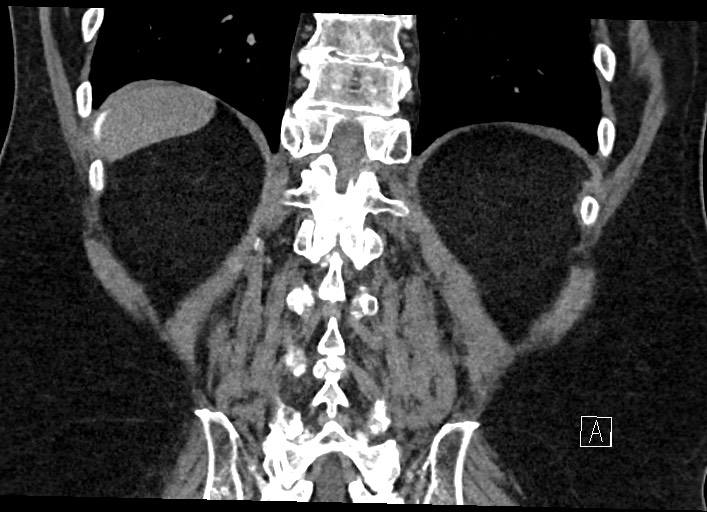 File:Buried bumper syndrome - gastrostomy tube (Radiopaedia 63843-72577 Coronal Inject 113).jpg