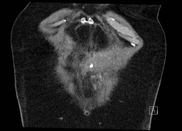 Buried bumper syndrome - gastrostomy tube (Radiopaedia 63843-72577 Coronal Inject 19).jpg