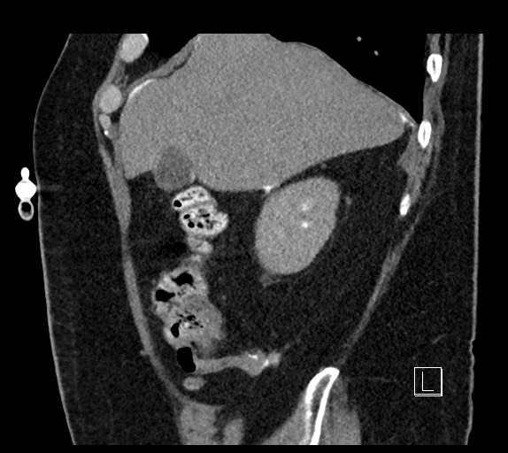 Buried bumper syndrome - gastrostomy tube (Radiopaedia 63843-72577 Sagittal Inject 95).jpg