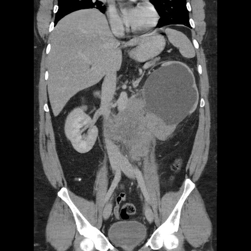 Burned-out testicular seminoma - retroperitoneal nodal metastases (Radiopaedia 62872-71245 B 36).jpg