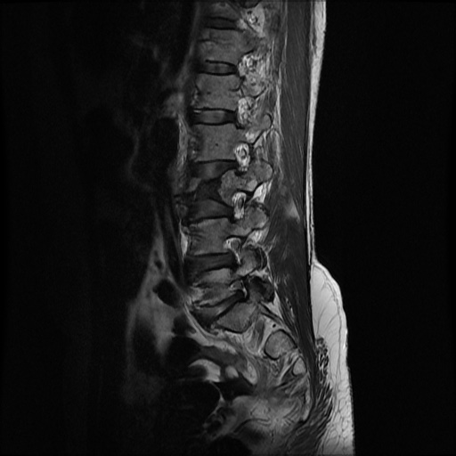 File:Burst fracture - lumbar spine (Radiopaedia 72877-83541 Sagittal T2 2).jpg