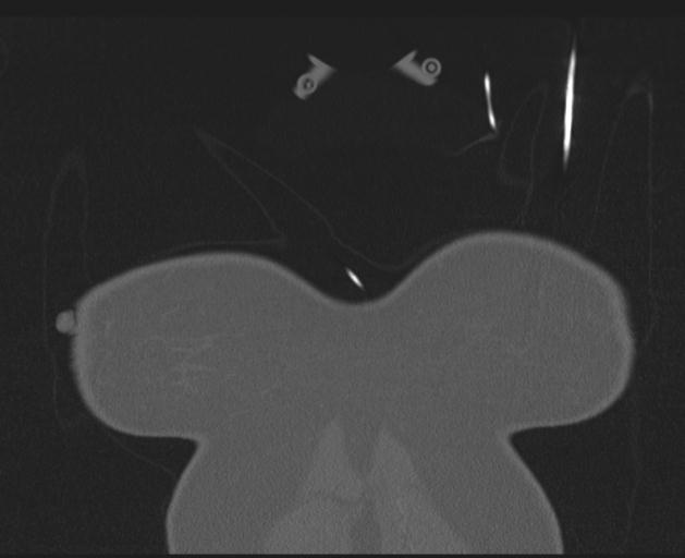 Burst fracture - thoracic spine (Radiopaedia 30238-30865 Coronal bone window 7).jpg