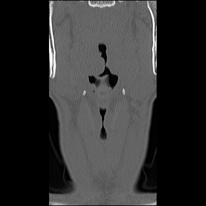 C5 facet fracture (Radiopaedia 58374-65499 Coronal bone window 10).jpg