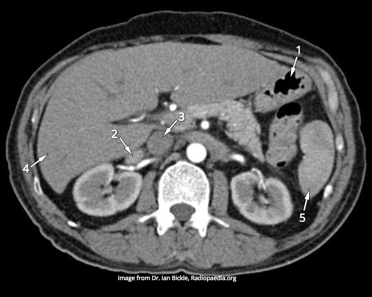 File:CT abdomen (anatomy quiz) (Radiopaedia 60335).jpg