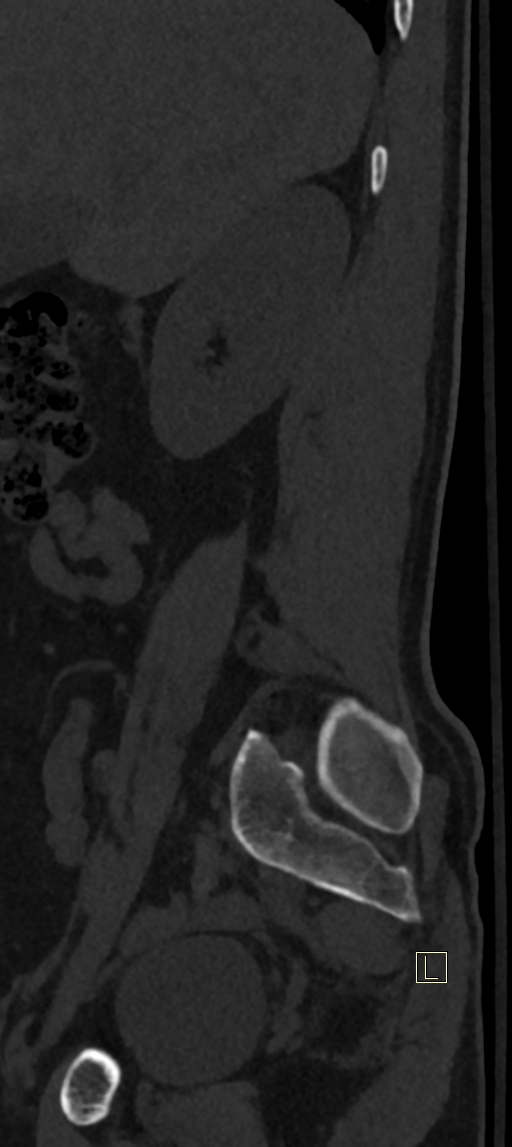 Calcaneal fractures with associated L2 burst fracture (Radiopaedia 71671-82493 Sagittal bone window 78).jpg