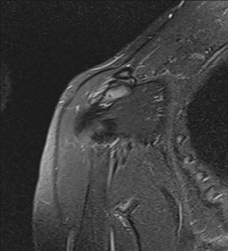 File:Calcific tendinitis of the infraspinatus tendon (Radiopaedia 87256-103537 Coronal PD fat sat 6).jpg