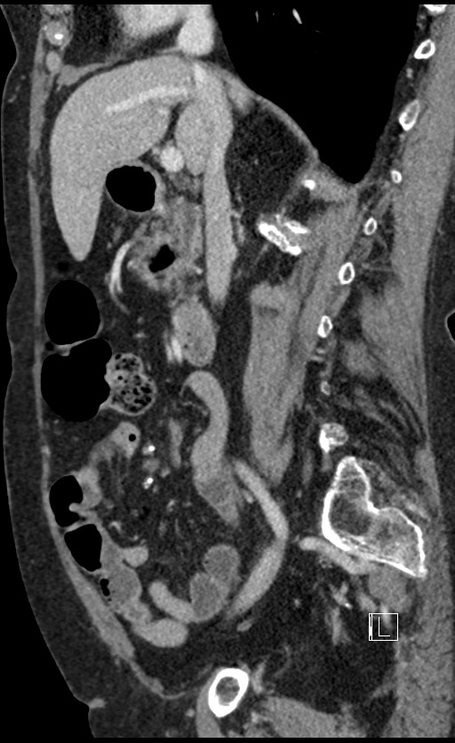 Calcified adrenal glands and Spigelian hernia (Radiopaedia 49741-54988 C 98).jpg