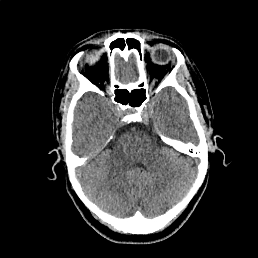 File:Calcified cerebral hydatid cyst (Radiopaedia 65603-74717 Axial non-contrast 15).jpg