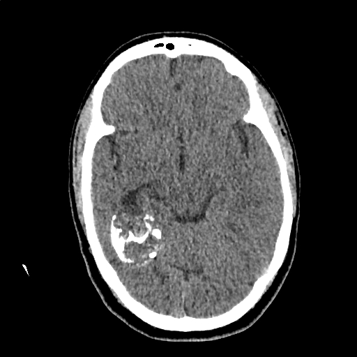 Calcified cerebral hydatid cyst (Radiopaedia 65603-74717 Axial non-contrast 27).jpg