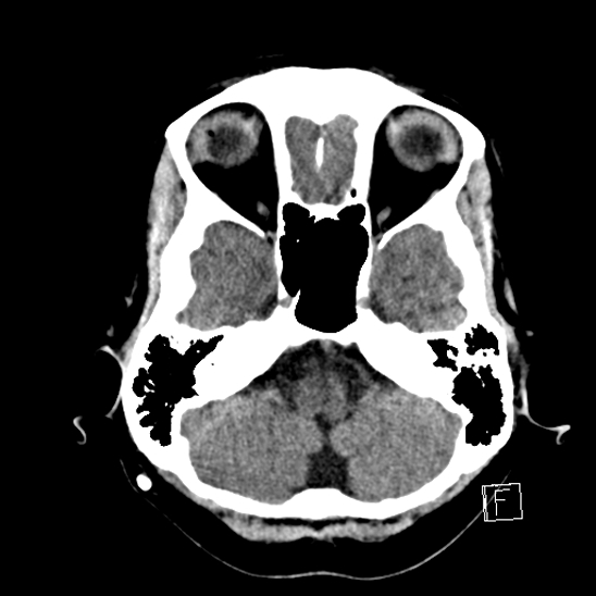 File:Calcified chronic subdural hematoma (Radiopaedia 77374-89492 Axial non-contrast 10).jpg