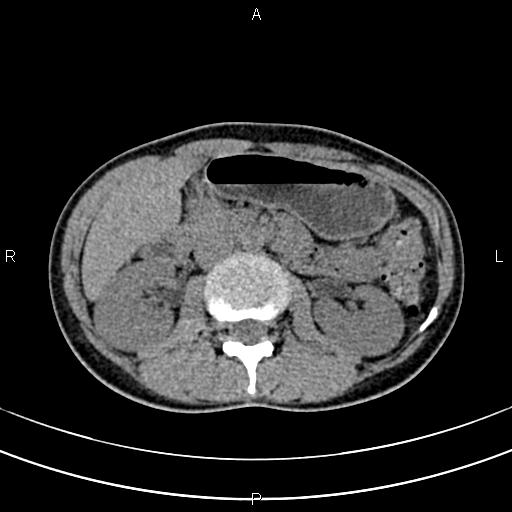 File:Calcified hepatic hydatid cyst (Radiopaedia 83870-99072 Axial non-contrast 74).jpg