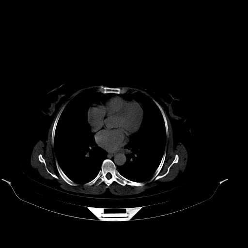 File:Calcified hydatid cyst of the liver (Radiopaedia 21212-21112 Axial bone window 3).jpg
