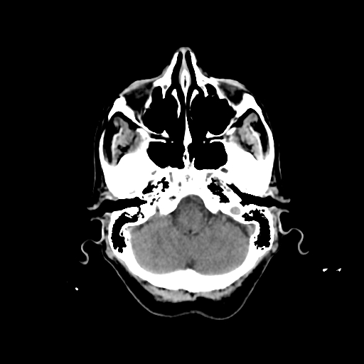 File:Calcified meningioma - cervical canal (Radiopaedia 70136-80171 Axial non-contrast 6).jpg