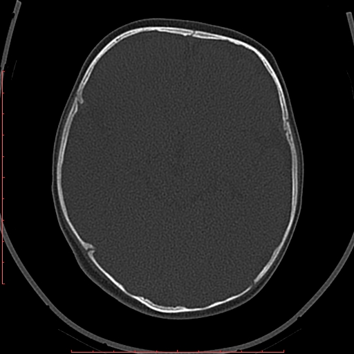 Calcified middle cerebral artery embolism (Radiopaedia 78949-91860 Axial bone window 23).jpg