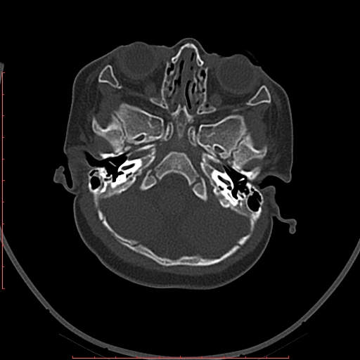 Calcified middle cerebral artery embolism (Radiopaedia 78949-91860 Axial bone window 3).jpg