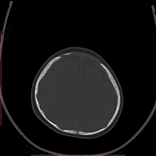 Calcified middle cerebral artery embolism (Radiopaedia 78949-91860 Axial bone window 62).jpg