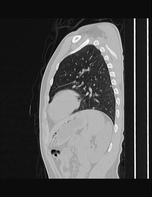 Calcifying pulmonary metastases (Radiopaedia 33359-34396 Sagittal lung window 19).jpg