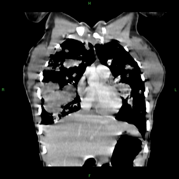 File:Cannon ball metastases - synovial sarcoma (Radiopaedia 26135-26271 Coronal liver window 3).jpg