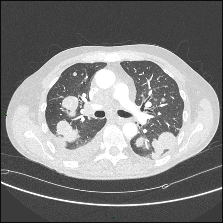 Cannonball metastases (Radiopaedia 82110-96150 Axial lung window 88).jpg