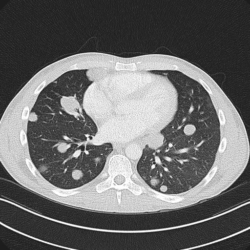 Cannonball metastases - testicular choriocarcinoma (Radiopaedia 84510-99891 Axial lung window 60).jpg